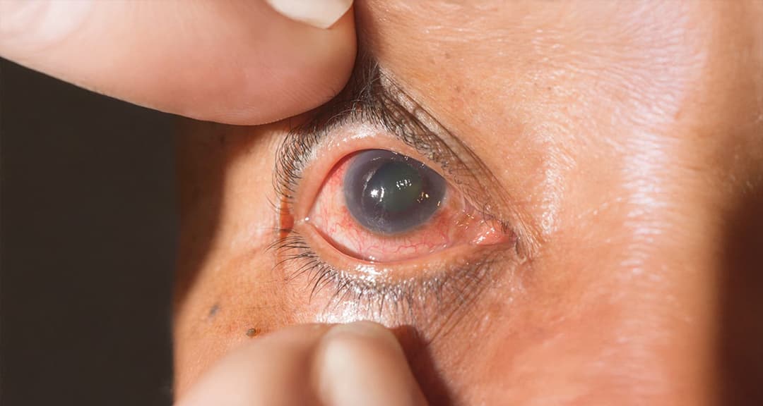 Glaucoma Awareness Month 2026: Early Detection Is Key to Stopping the Silent Thief of Sight