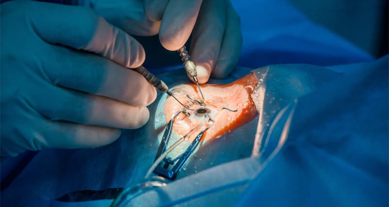 Benefits of Cataract Surgery for Better Vision in Daily Life