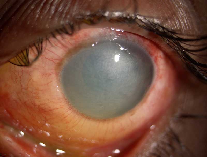 Clouded cornea photographed at Mungale Eye Hospital