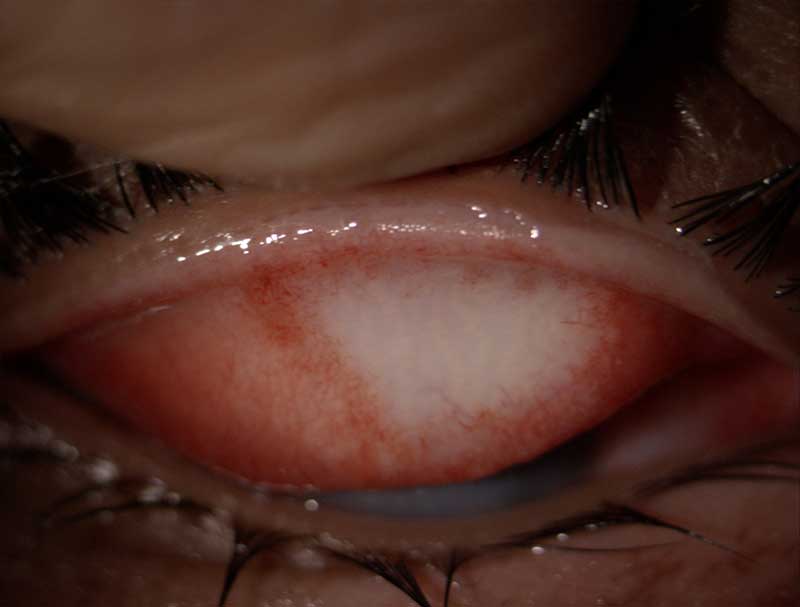 Chemical burn clinical photograph at Mungale Eye Hospital