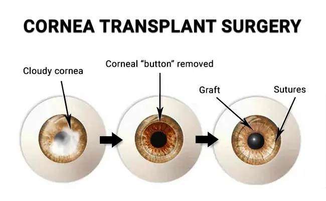 Corneal transplantation surgery diagram used at Mungale Eye Hospital