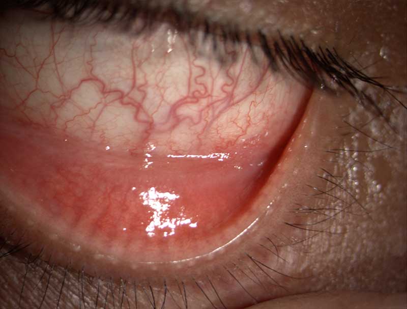 Dry eye clinical photograph at Mungale Eye Hospital