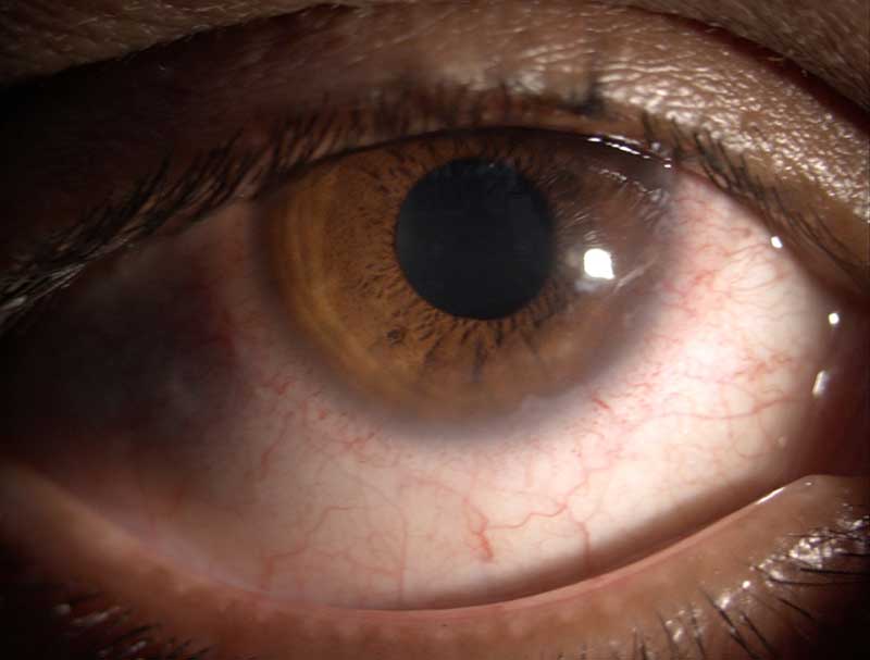 Dry eye clinical photograph at Mungale Eye Hospital