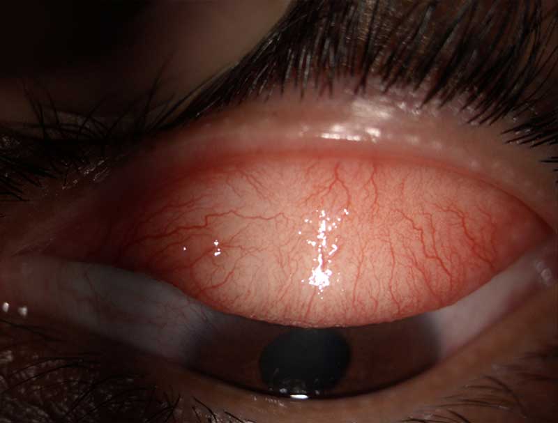 Dry eye clinical photograph at Mungale Eye Hospital