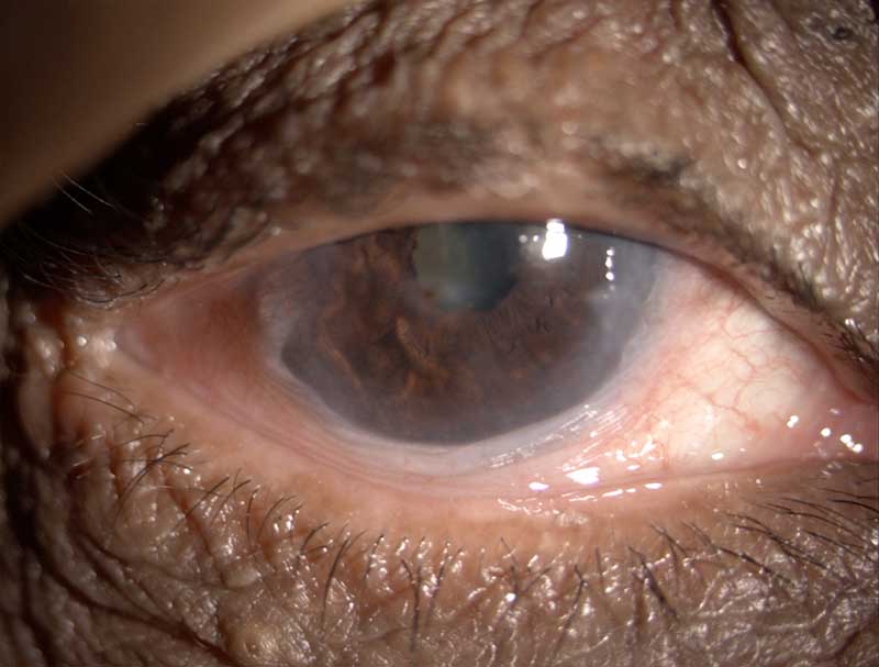Dry eye clinical photograph at Mungale Eye Hospital