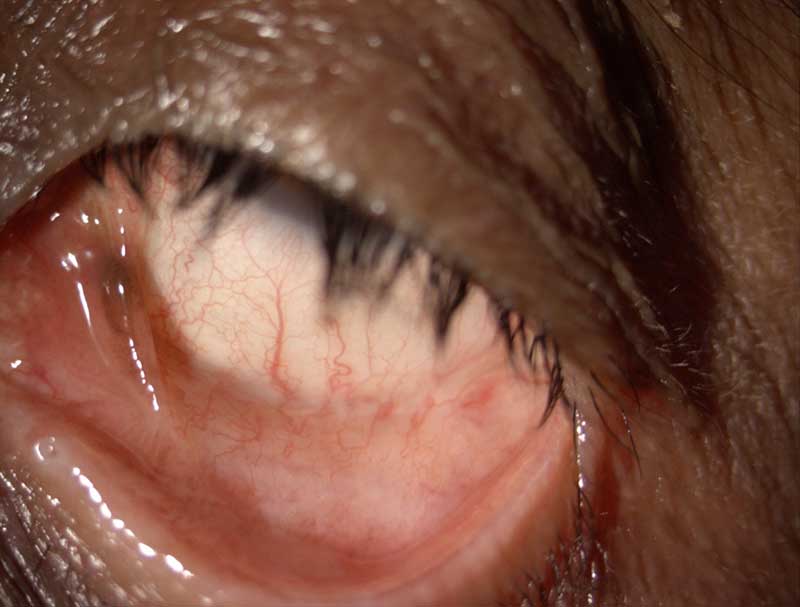 Dry eye clinical photograph at Mungale Eye Hospital