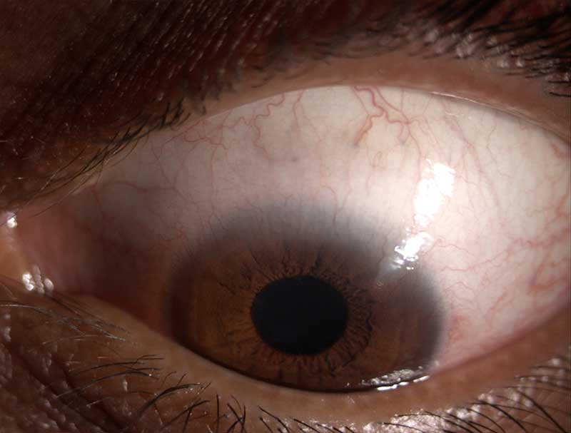 Dry eye clinical photograph at Mungale Eye Hospital