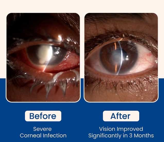 Corneal infection clinical photograph at Mungale Eye Hospital