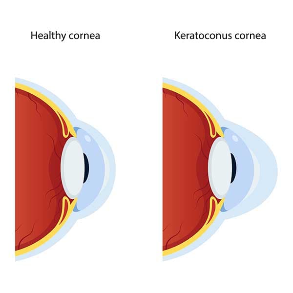 Healthy versus keratoconus cornea illustration