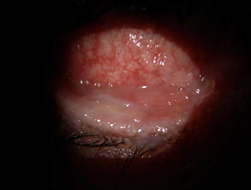 Stevens-Johnson syndrome clinical photograph at Mungale Eye Hospital