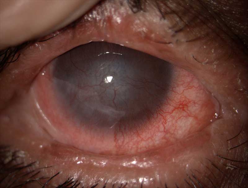 Stevens-Johnson syndrome clinical photograph at Mungale Eye Hospital