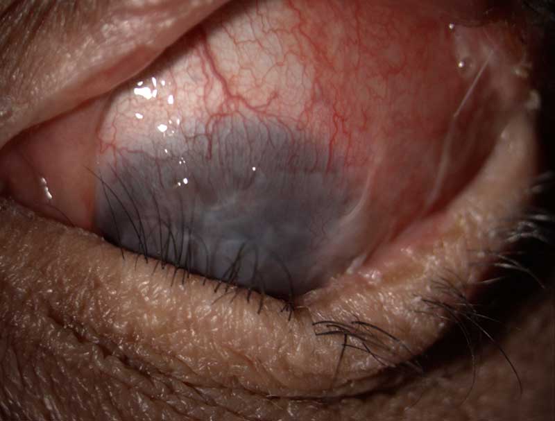 Stevens-Johnson syndrome clinical photograph at Mungale Eye Hospital